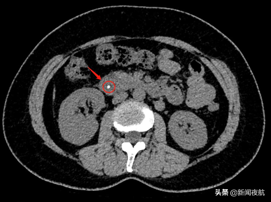 一名女子体内取出3000多颗胆结石,胆结石取出活虫