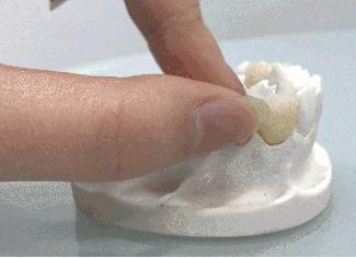 种植牙和烤瓷牙的知识大全,种植牙vs烤瓷牙到底哪个好