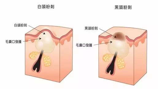 盘点一下各种去黑头办法的优缺点,有效去黑头就看这一招