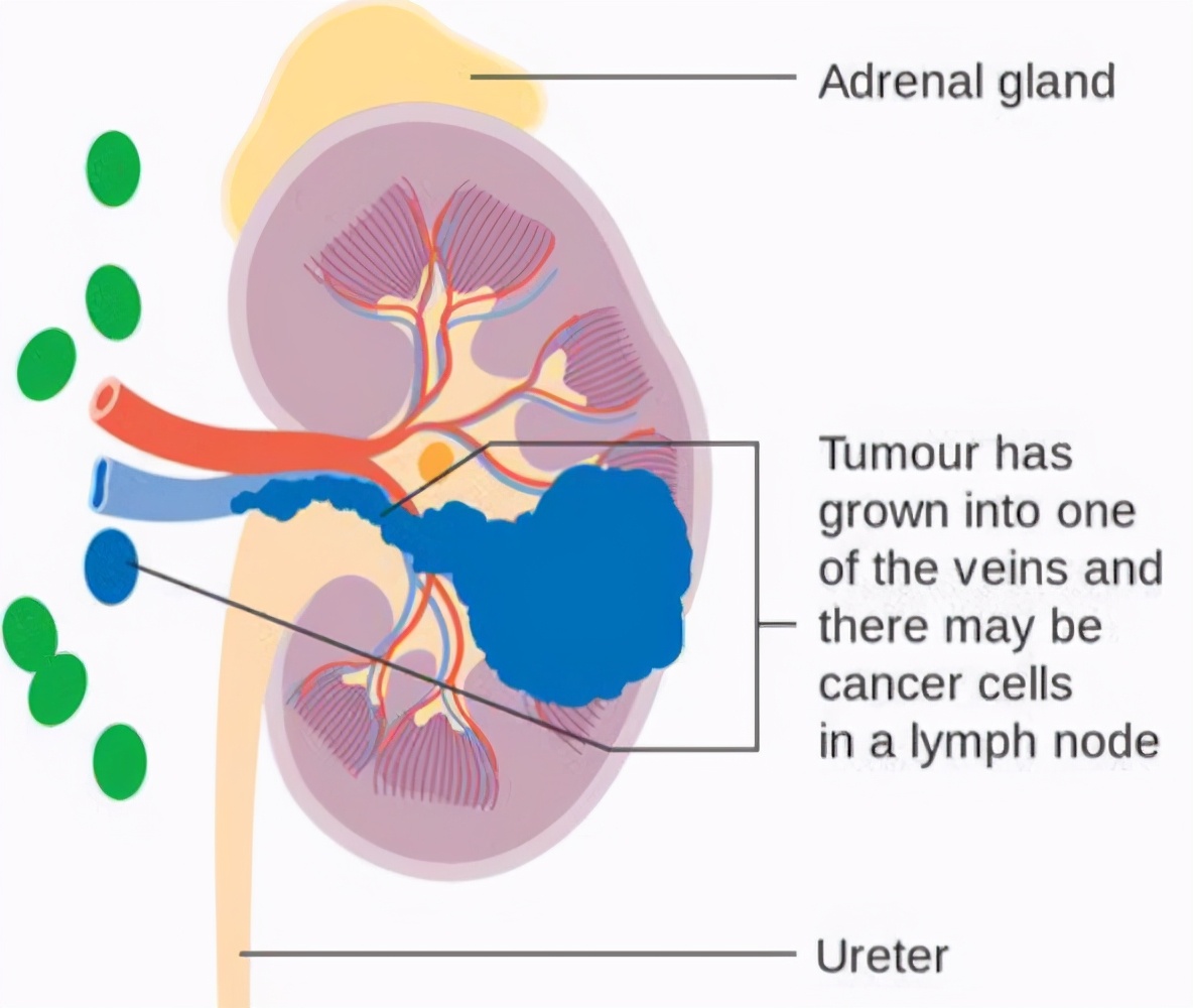 输尿管结石吃七种食物最好,输尿管结石禁吃食物