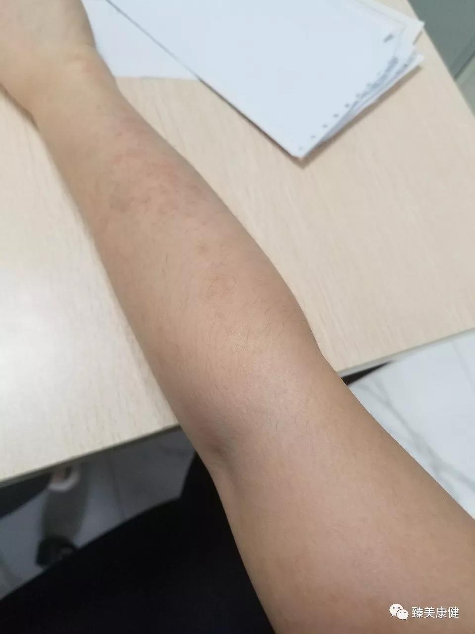 胃苓丸加什么药治湿疹,除湿胃苓丸治疗湿疹