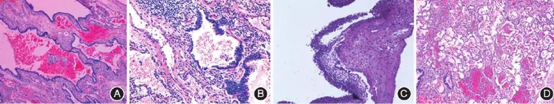 呼吸性疾病,呼吸内科间质性肺疾病