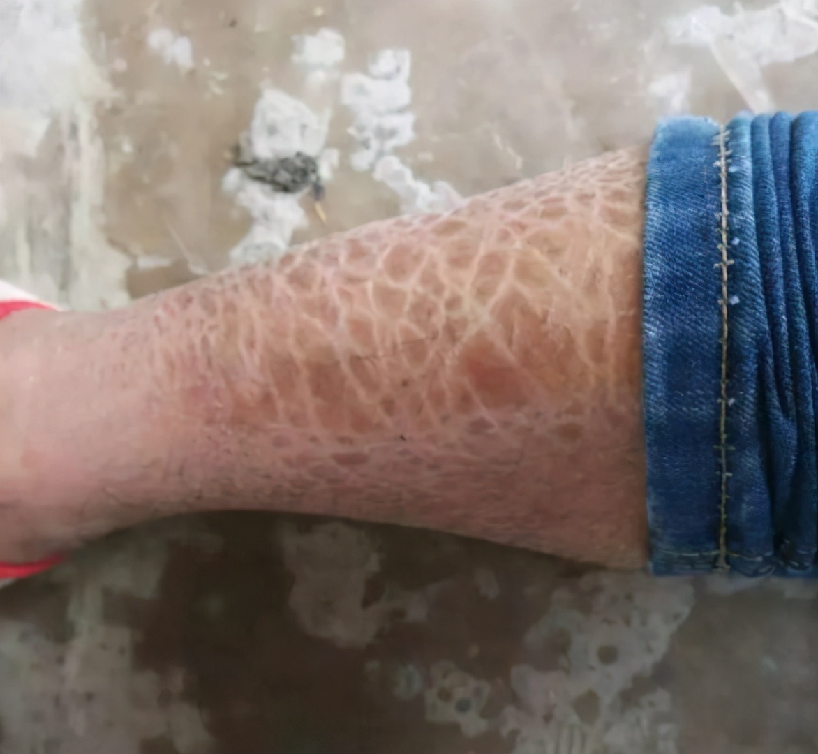 如何消除鸡皮肤学生党,告别蛇皮肌肤