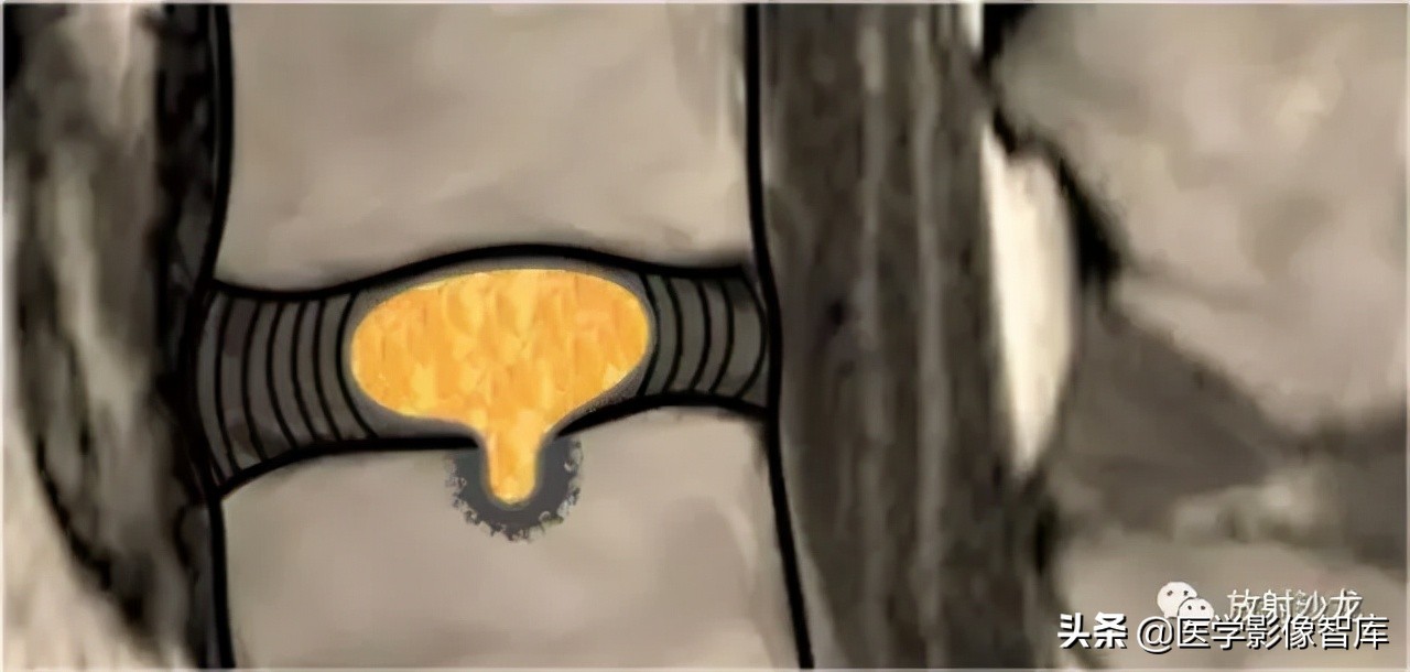 一键收藏所有的内容,颈椎间盘病变的症状和治疗