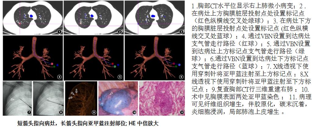 小细胞肺癌的气管镜介入治疗,导航支气管镜在肺癌诊断中的应用