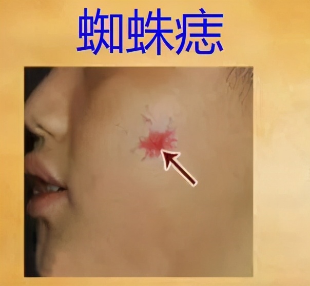 谷草转氨酶高会影响入职体检吗,体检谷草转氨酶ast偏高代表什么