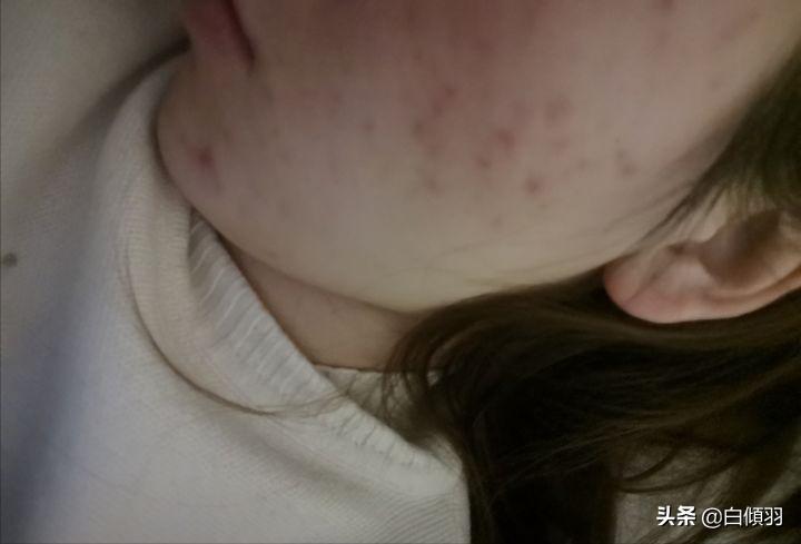 红肿痘痘不疼了但是还是有包,红肿痘痘摸着软软的一直不冒白头