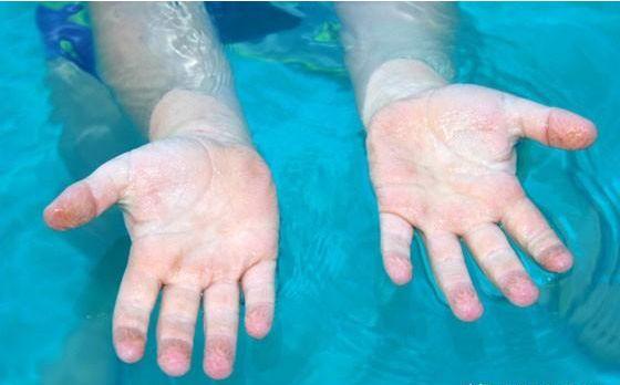 为什么手指泡水后凹凸不平,手指泡水后变腐烂怎么办