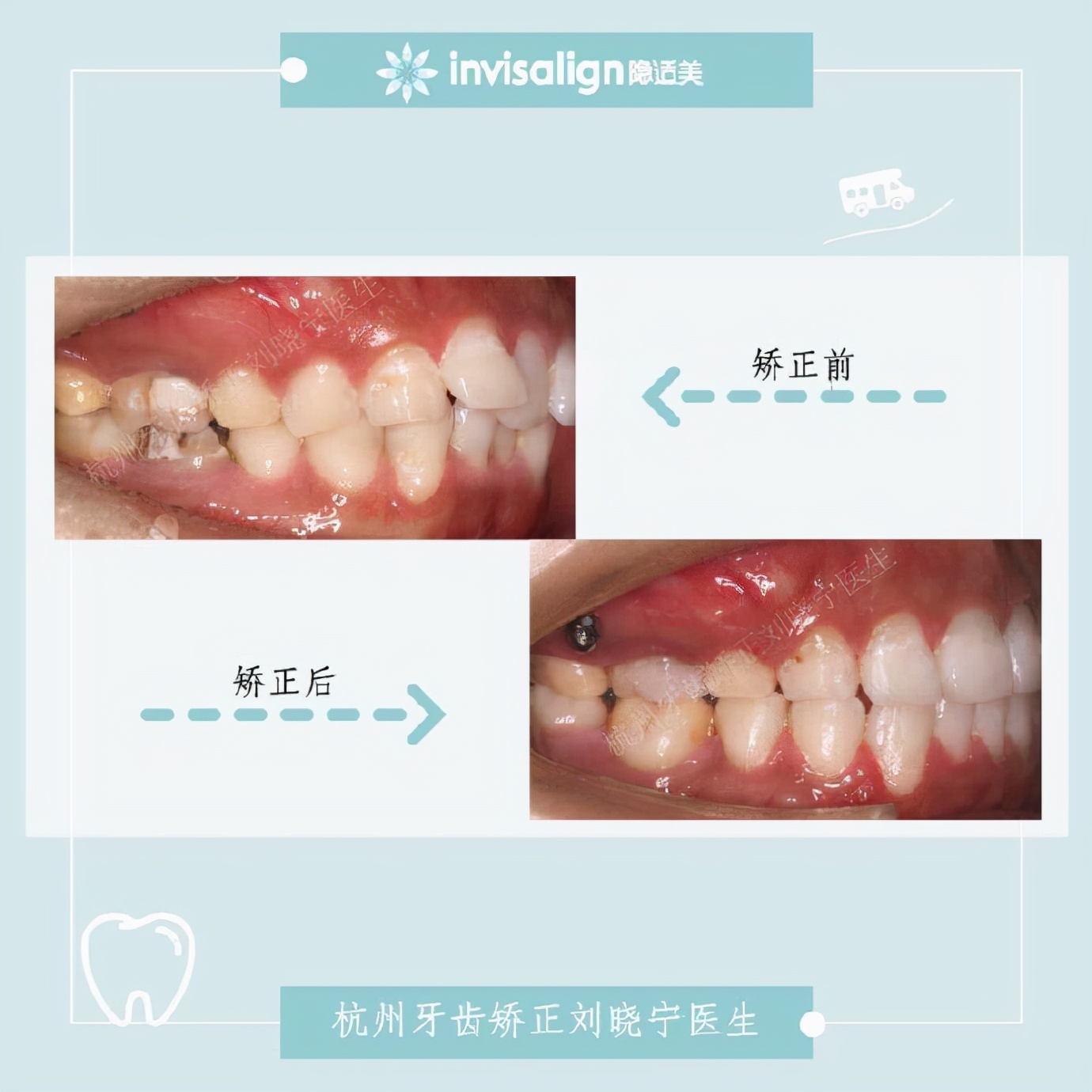 矫正牙齿如何改善露龈笑,矫正牙齿可以改善露龈笑吗