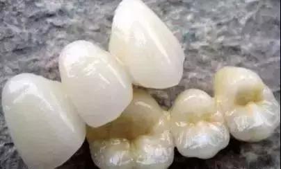 想配一副全瓷假牙要多少钱,做镍铬合金好还是钴铬烤瓷牙好