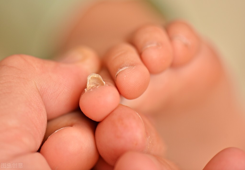 足癣不是真菌感染怎么治,足癣怎么治疗好得快