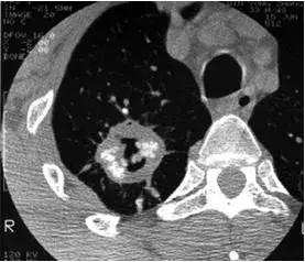 肺部ct十大征象,肺部ct正常图和异常图的区别