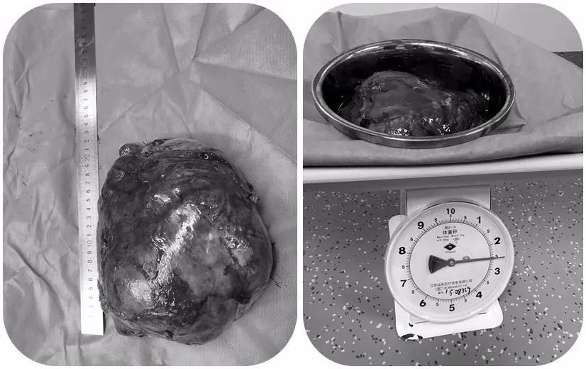 漳州第三医院：一男子高烧39.8℃被紧急送医，检查后发现肚里居然藏着“定时*弹炸**”