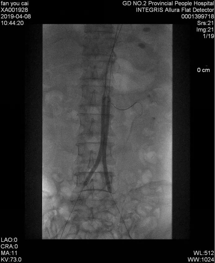 老烟民请注意,老烟民血管收缩