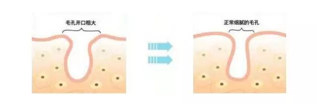 毛孔粗大皮肤暗黄干燥怎么办,毛孔粗大皮肤暗黄怎么治疗