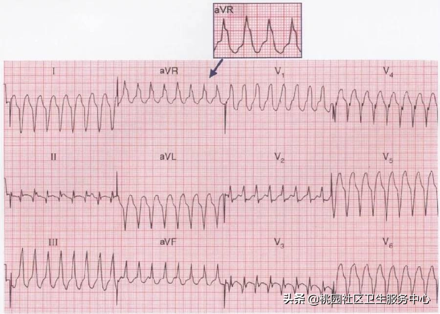 心电图危险指数两颗星,高危心电图的识别