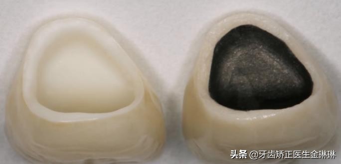 烤瓷牙颜色太黄了怎么办,烤瓷牙变黄了怎么变白