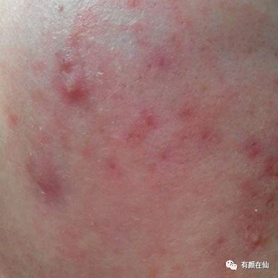 如何消除红色痘印,后背红色痘印怎么消除