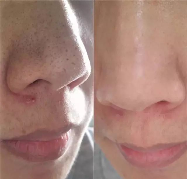 毛孔粗大皮肤暗黄干燥怎么办,毛孔粗大皮肤暗黄怎么治疗