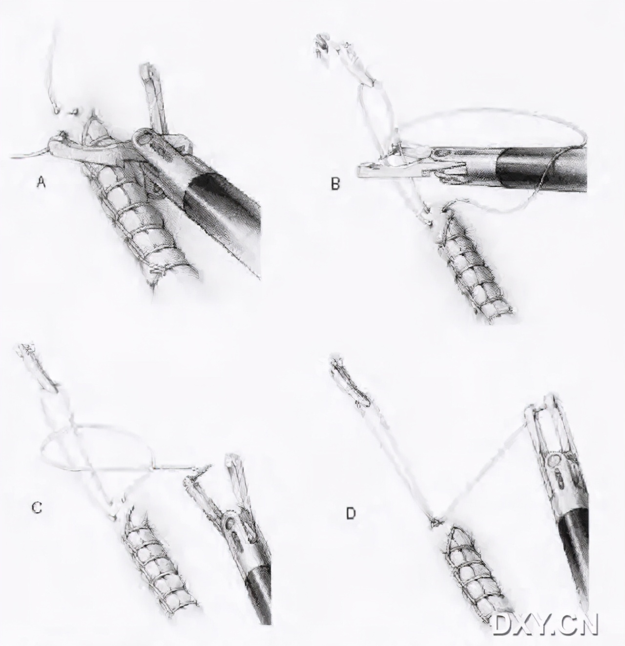 实用大全：腹腔镜下缝合与打结