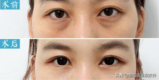 下眼皮松弛没有眼袋可以动手术吗,下眼皮内翻不做手术行不行