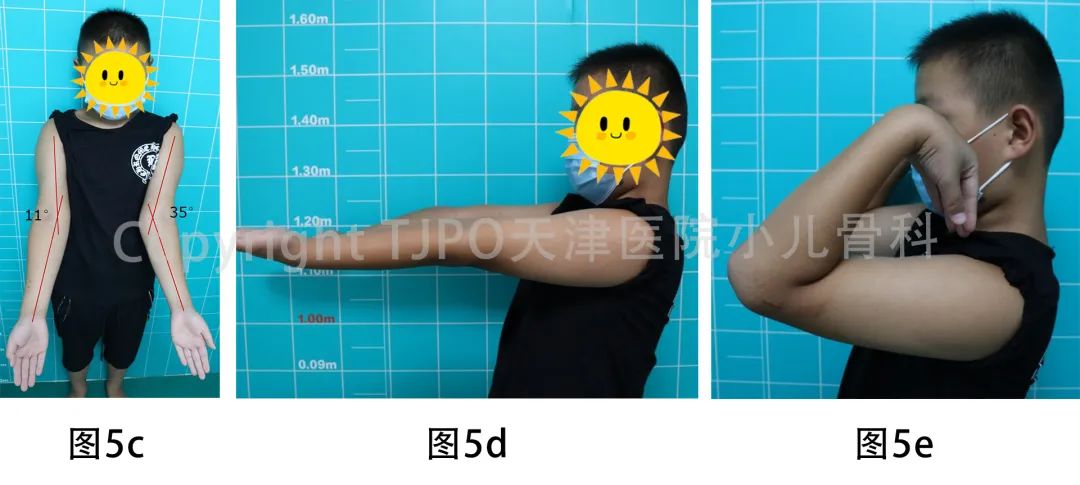 肱骨髁上骨折如何预防肘外翻畸形,肱骨髁上骨折外翻畸形原因