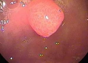 胃息肉癌变怎么治疗,胃息肉一定会癌变吗