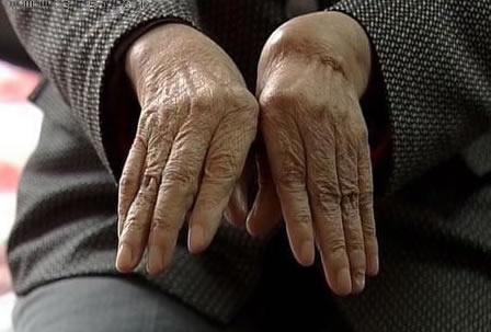 清早起床手指关节僵硬是关节炎吗,类风湿关节炎的表现有哪些