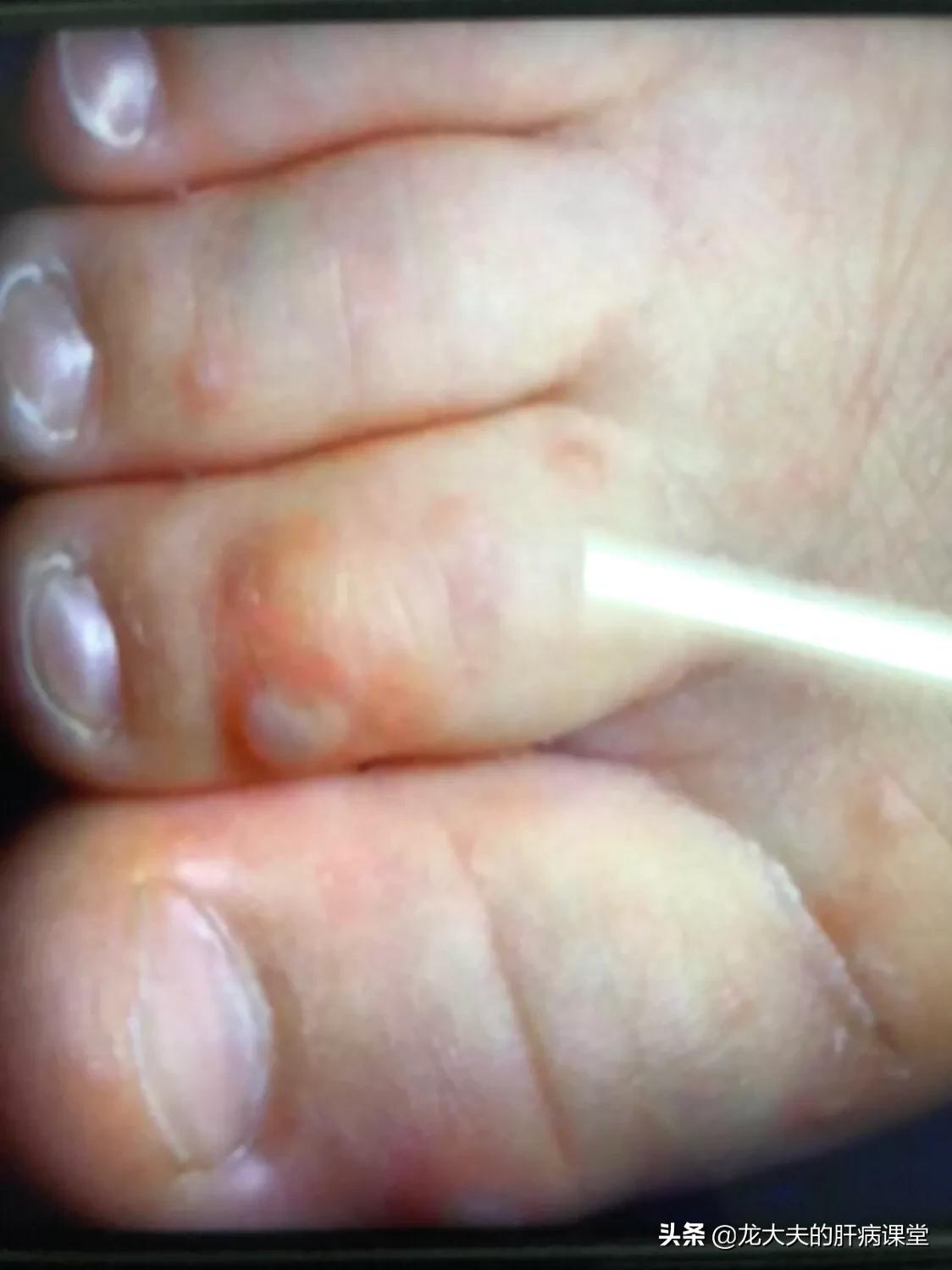 成年人得手足口病的最佳治疗方法,手足口病的注意事项以及治疗方法