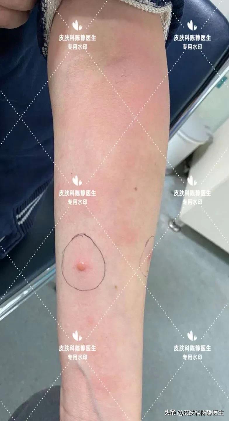 为什么别人咬你会疼,为什么被别人咬了之后一直好疼