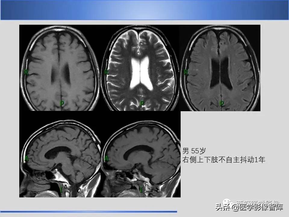 vr间隙概念,vr间隙需要做什么检查