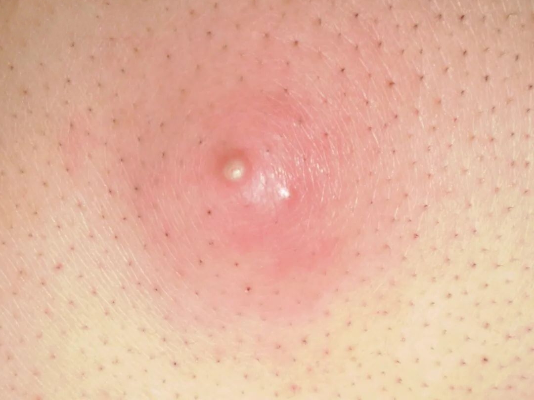 “医生，我为什么会发生皮脂腺囊肿呢？”#健康科普挑战赛#