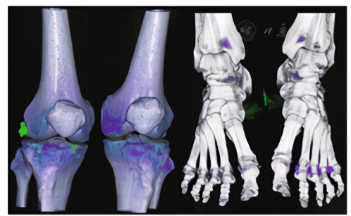 痛风性膝关节炎能治好吗,痛风性膝关节炎肿胀的治疗