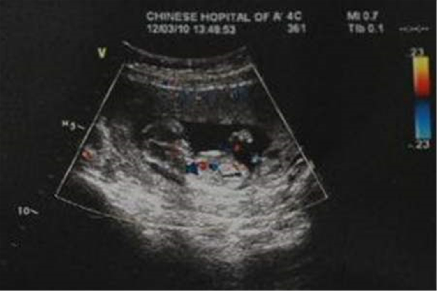 nt排畸检查是检查什么,什么是nt检查要憋尿吗