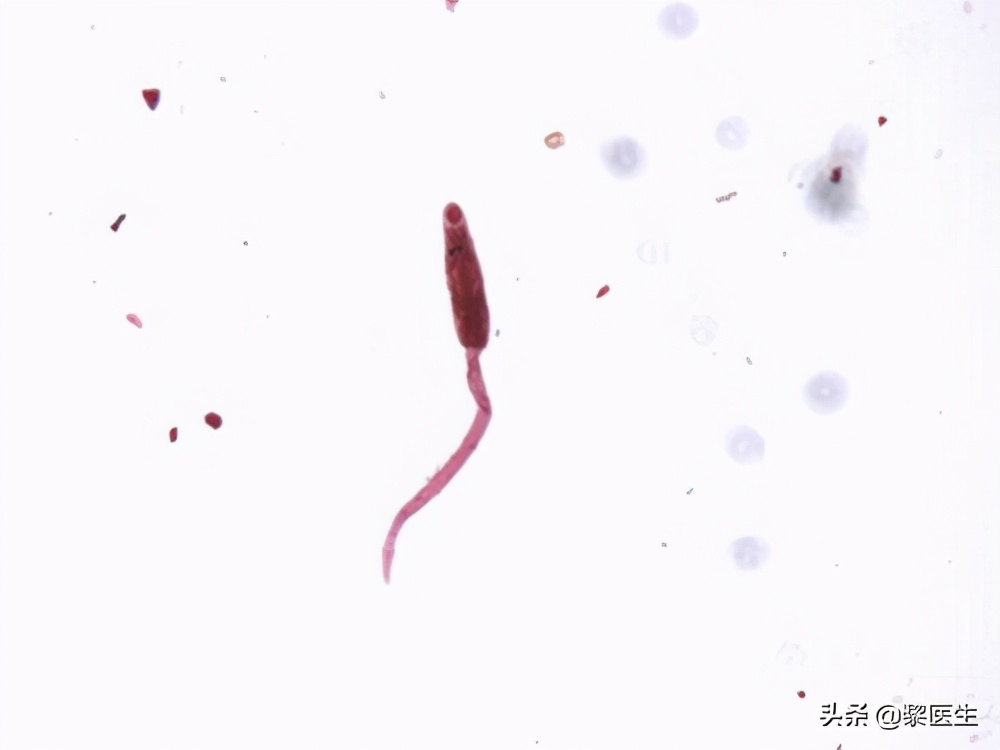 得了肝吸虫病有什么症状吗,肝吸虫感染有什么征兆