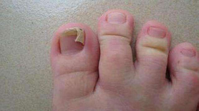 脚趾甲甲沟炎如何自己处理,甲沟炎指甲残留到肉里红肿怎么办