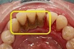 牙结石要怎么处理才干净,人牙结石处理过程