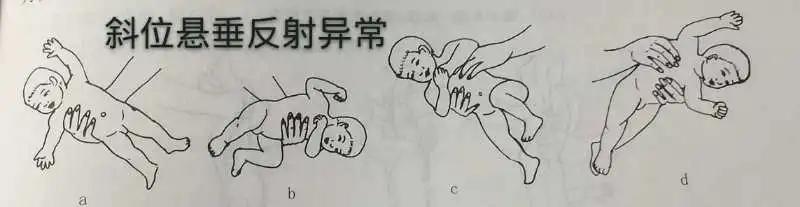 脑瘫儿童的七种异常姿势,判断宝宝脑瘫最简单的方法