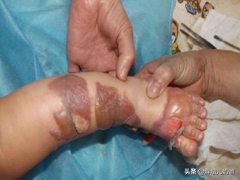 小腿烫伤结痂了还需用纱布包扎吗,小腿被开水烫伤起泡了该怎么处理