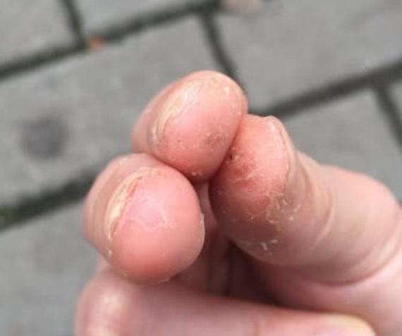 7岁孩子手指上换季脱皮,手指脱皮是身体求救信号