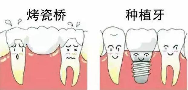 种植牙和烤瓷牙究竟有哪些区别？为什么都说种植牙好？