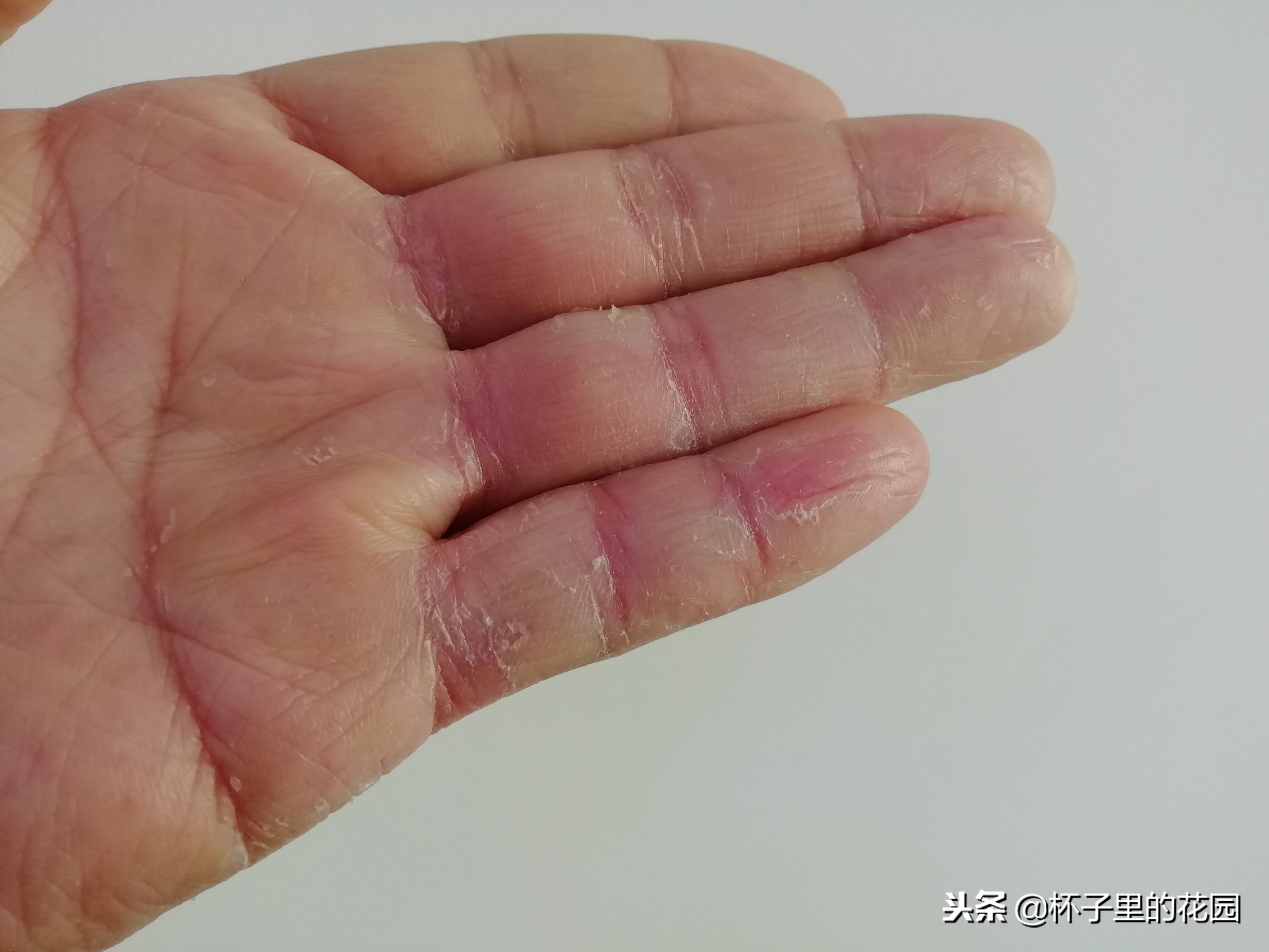 手脱皮因为缺少哪种维生素,手脱皮是缺少哪种维生素