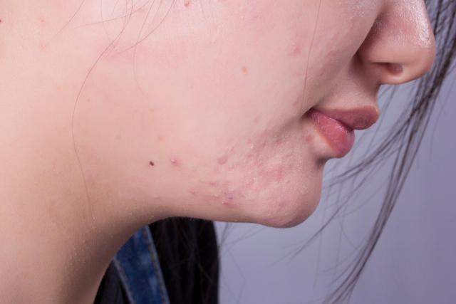 头发上有白色小颗粒怎么回事,掉的头发根部有白色颗粒怎么治