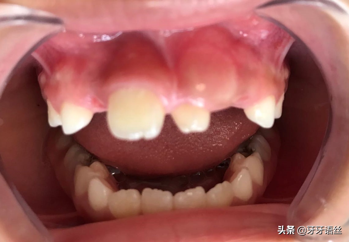 儿童龋齿的病因及预防诊治,儿童龋齿的病因及预防