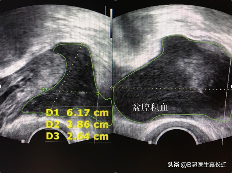 盆腔积液会导致肚子痛嘛,盆腔积液会引起肚子疼腰不舒服吧