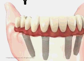 种植牙第一次拆线后的步骤,种植牙二期修复取模的步骤