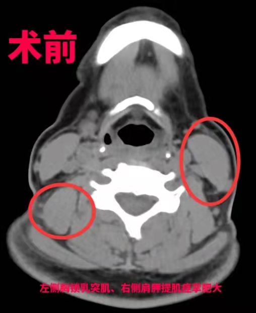 矫正脖子歪的手术是怎样的,治疗歪颈视频