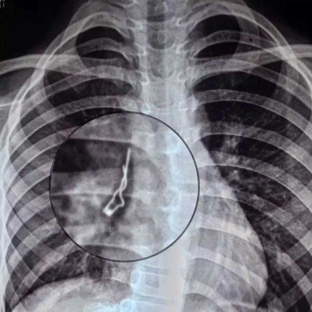 2岁孩子误吞了个小勺子,2岁宝宝误吞枣核第二天没拉出来