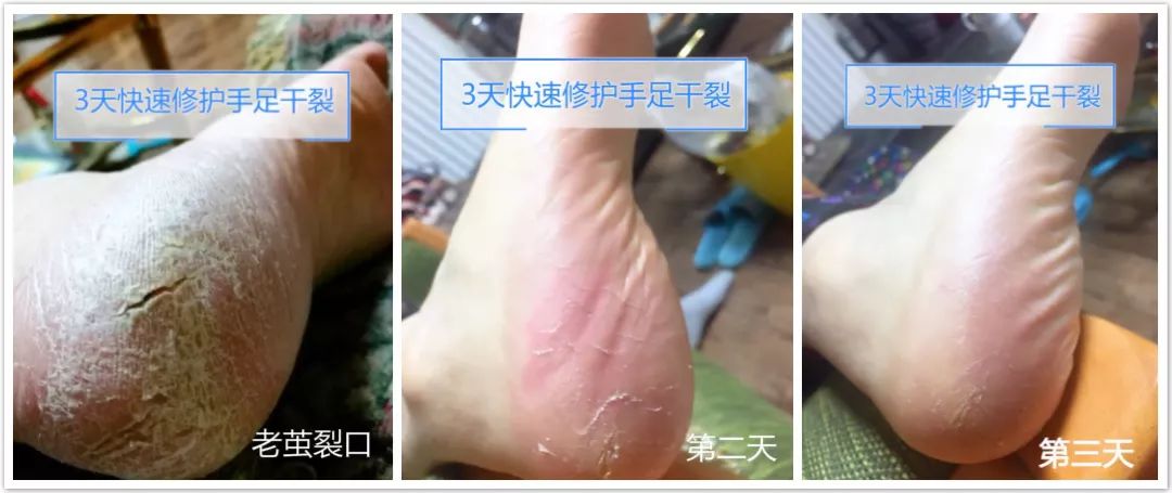 冬天脚跟干裂又起皮怎么办,冬天脚跟干裂起硬皮擦什么保湿好