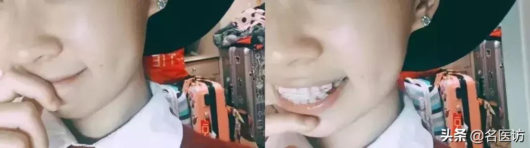 戴牙套2年不戴保持器反弹案例,戴牙套成功案例不戴保持器